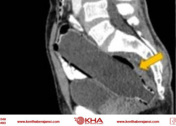 Doktorlar şaşkına döndü: Makatından pet şişe çıkartıldı!