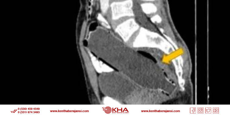 Doktorlar şaşkına döndü: Makatından pet şişe çıkartıldı!