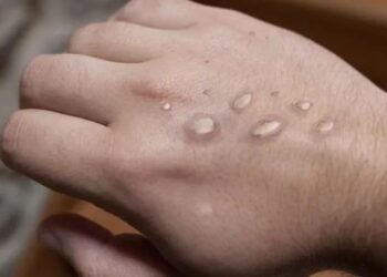 Maymun çiçeği vakaları yüzde 20 arttı