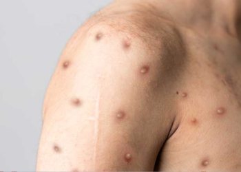 Maymun çiçeği vakası’e yükseldi