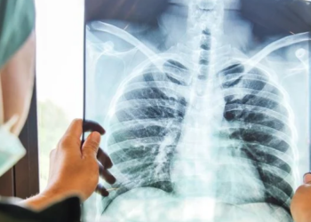 Akciğer sağlığı için ne tüketilmeli? Akciğere ne iyi gelir?