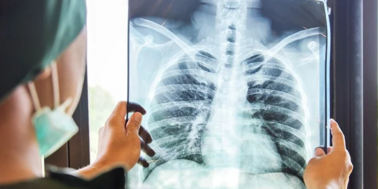 Akciğer sağlığı için ne tüketilmeli? Akciğere ne iyi gelir?