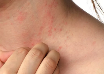 Kaşıntı ve döküntüye dikkat! Uyuz olabilirsiniz…