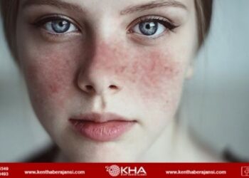 Lupus (Kelebek hastalığı) nedir, belirtileri neler?