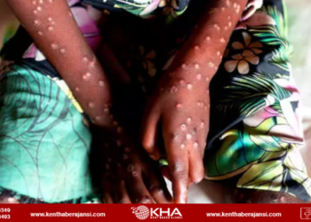 Türkiye’de de görülen, Maymun Çiçeği Virüsünden koruyan yöntem açıklandı!