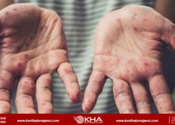 İlk maymun çiçeği vakası tespit edildi