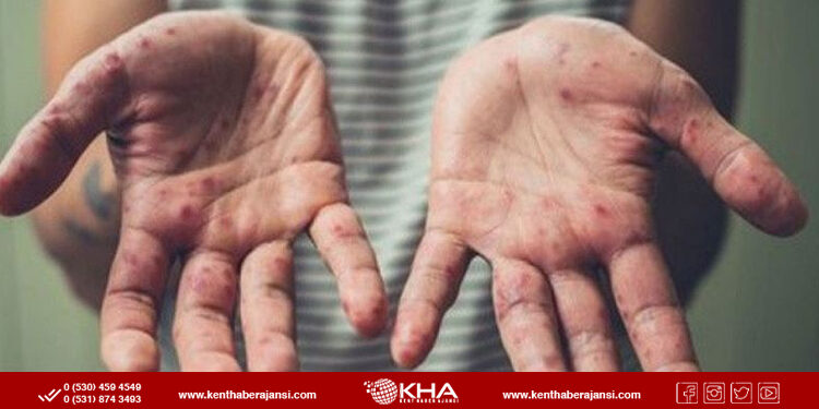 İlk maymun çiçeği vakası tespit edildi