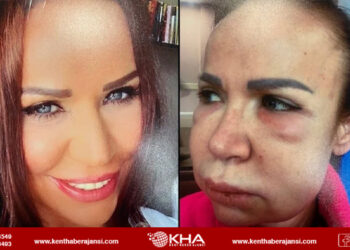 Estetik yaptıran kadının hayatı kabusa döndü!