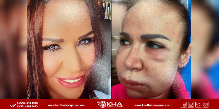 Estetik yaptıran kadının hayatı kabusa döndü!