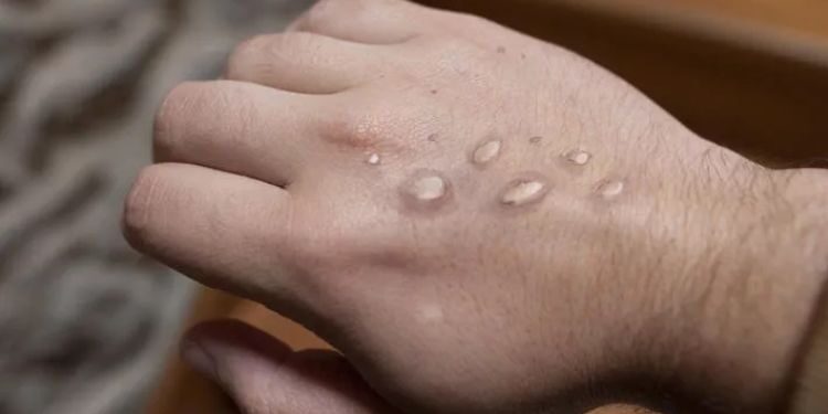 Maymun çiçeği vakaları yüzde 20 arttı