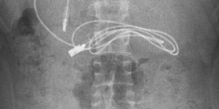Doktorlar  şok oldu: Midesinden şarj aleti kablosu çıkarıldı!