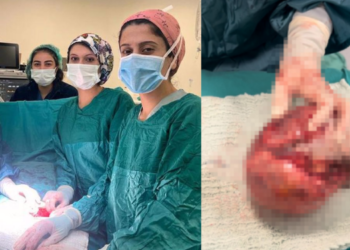 Doktorlar şok oldu! Karnından 2 buçuk kilo kitle çıktı!