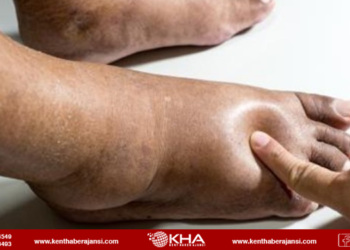 Ameliyatın ardından ödem nasıl atılır?