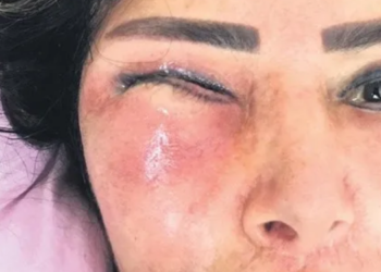 85 bin TL’lik yüz gerdirme operasyonu kabus yaşattı!