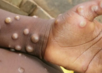 Açıklama geldi! Ankara’da maymun çiçeği karantinası var mı?