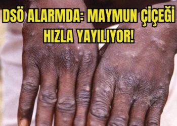 Hızla yayılıyor! Maymun Çiçeği  nedir? Nasıl Bulaşır?